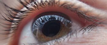 cataract causes